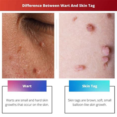 are skin tags similar to warts